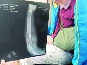 專車司機拒絕超載被乘客打成骨折 專車司機拒絕超載被乘客打成骨折